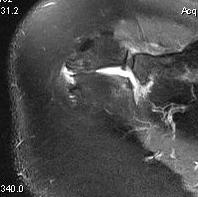 Os Acromionale MRI 1